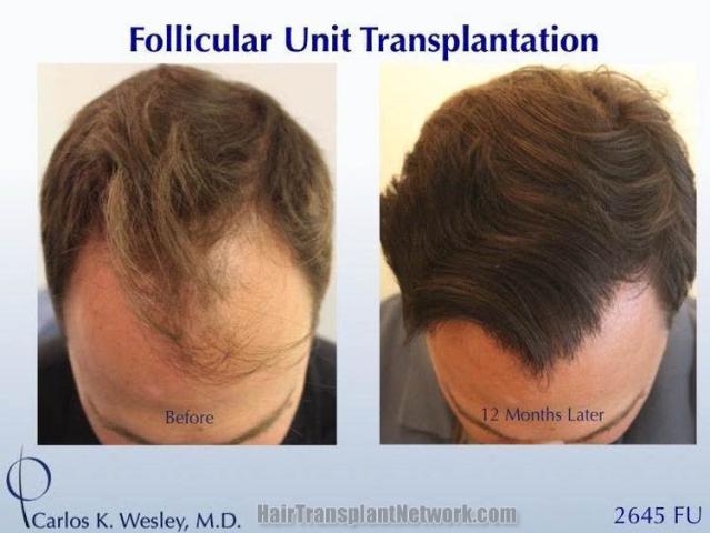 Before and after hair restoration procedure images