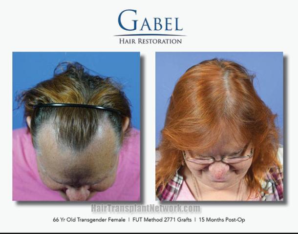 Hair transplantation surgery before and after images