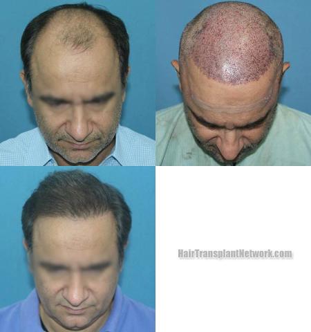 Hair transplantation surgery before and after images