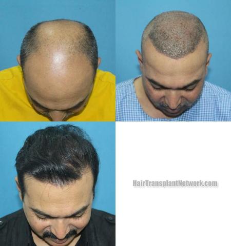 Hair transplantation surgery before and after images