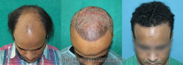 Hair transplantation surgery before and after images