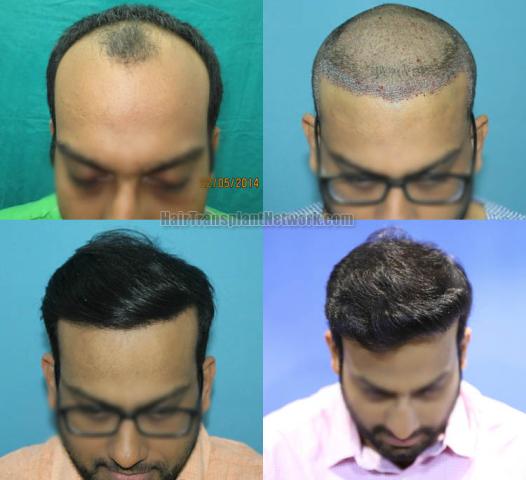 Hair transplantation surgery before and after images