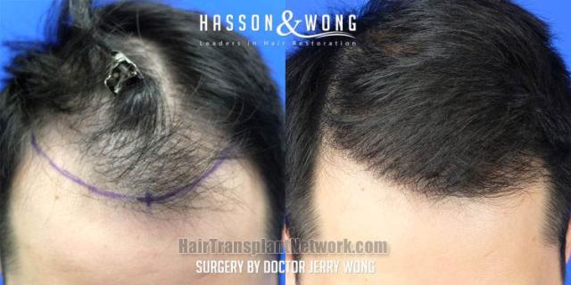 Hair transplantation surgery before and after images