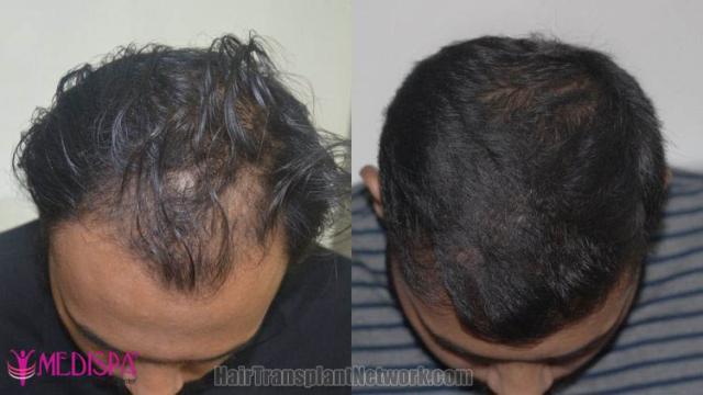 Hair transplantation surgery before and after images