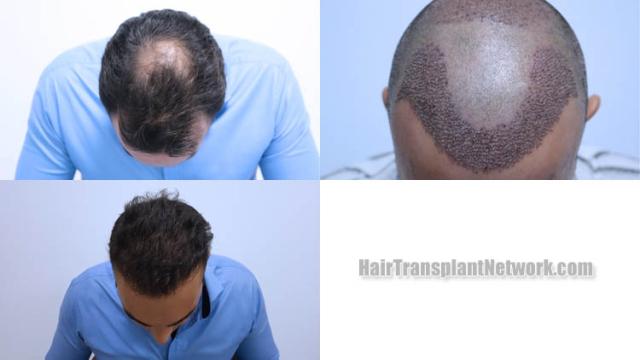 Hair transplantation surgery before and after images