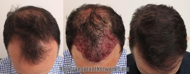 Hair transplantation surgery before and after images