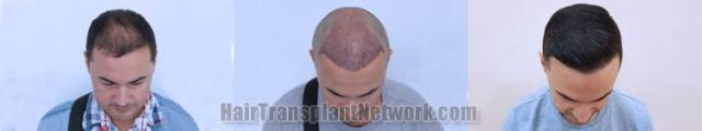 Hair transplantation surgery before and after images