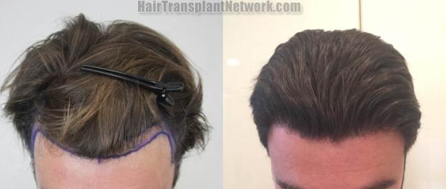 Hair transplantation surgery before and after images