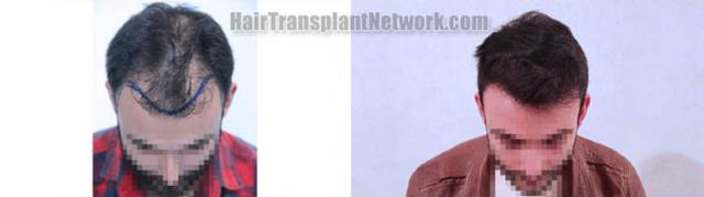 Hair transplantation surgery before and after images