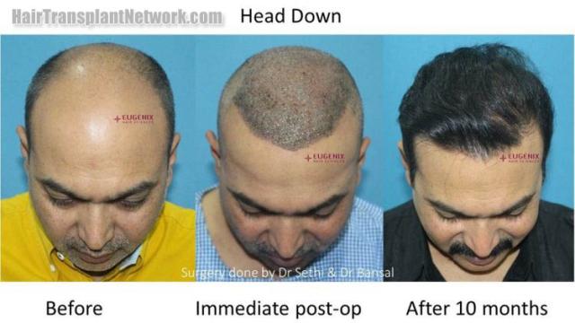 Hair transplantation surgery before and after images