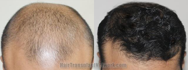 Top view - Before and after hair restoration results