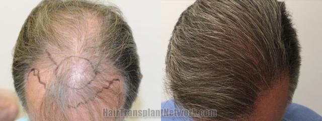 Top view - Before and after hair restoration results