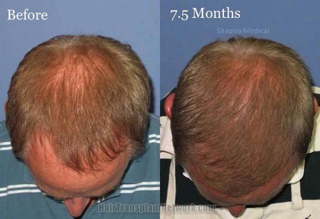 Top view before and after hair restoration results