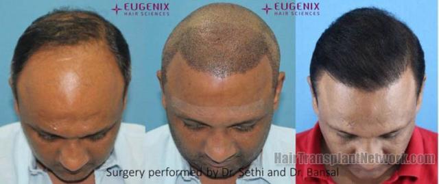 Before and after hair restoration procedure images