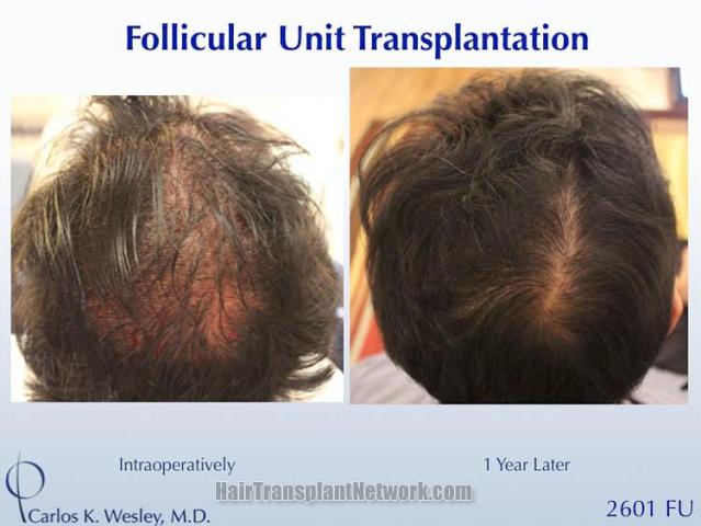 Hair transplantation procedure before and after results