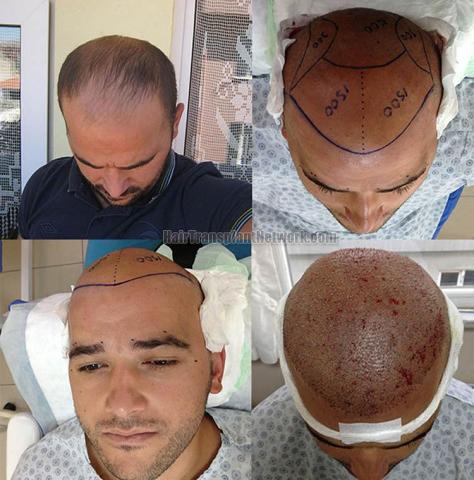 Hair transplant surgery before and after photos