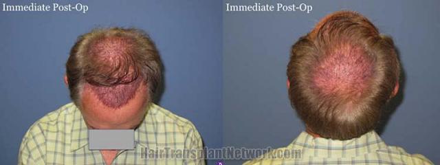 Surgical hair transplantation result photographs