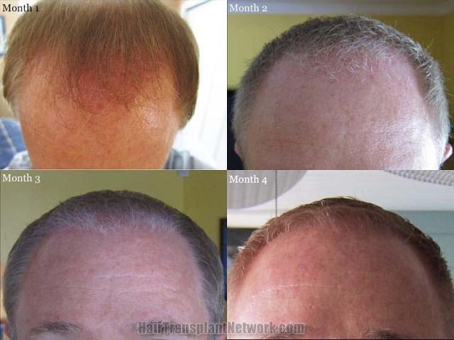 Hair restoration procedure before and after results