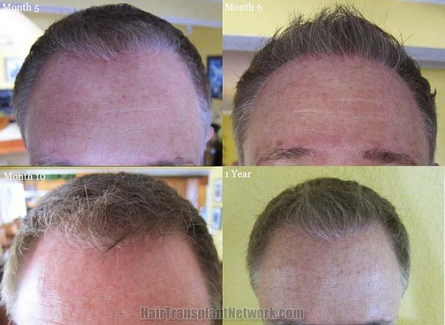 Hair transplantation surgery before and after images