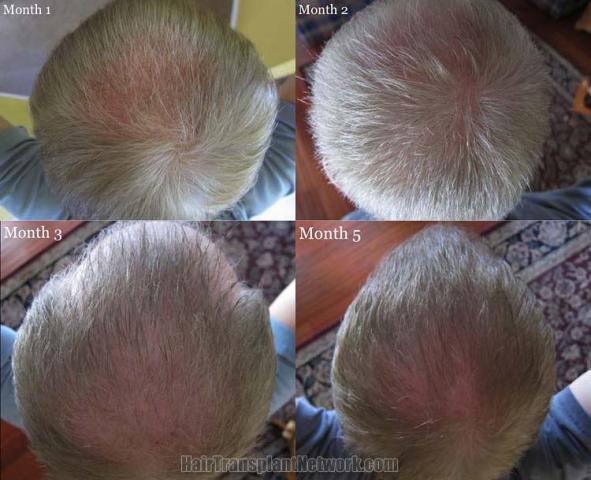 Hair transplantation surgery before and after photos