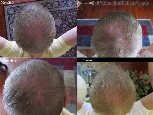 Hair transplantation surgery before and after pictures