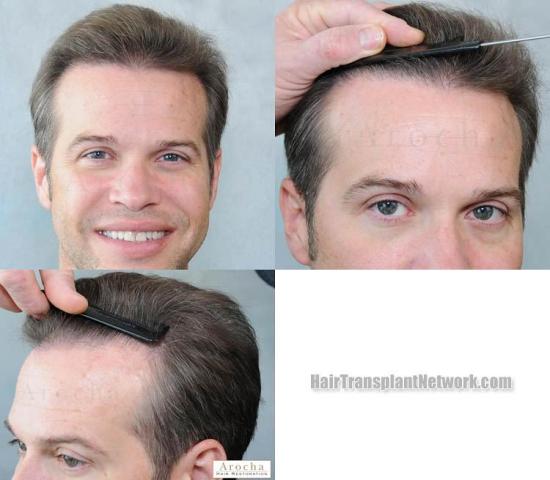 Hair restoration procedure before and after results