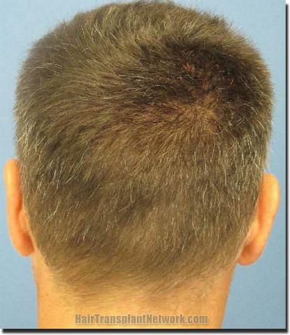 Hair restoration procedure results