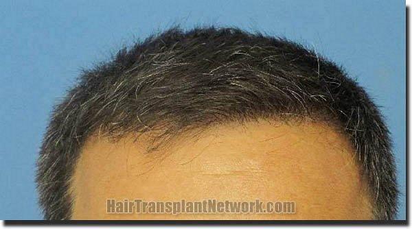 Hair restoration procedure results