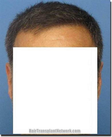 Hair restoration procedure results