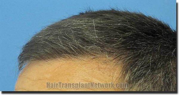 Hair restoration procedure results