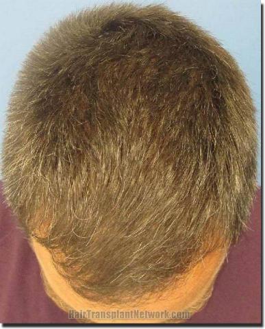 Hair restoration procedure results