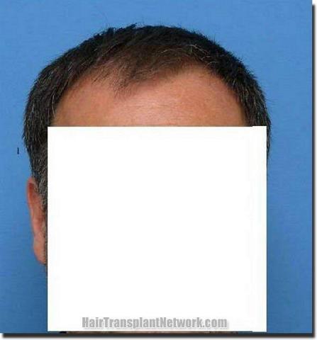 Hair restoration procedure results