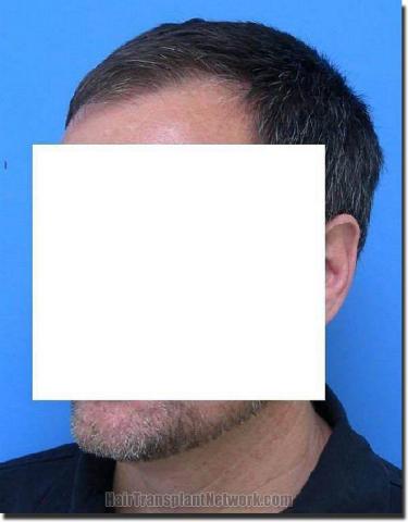 Hair restoration procedure results