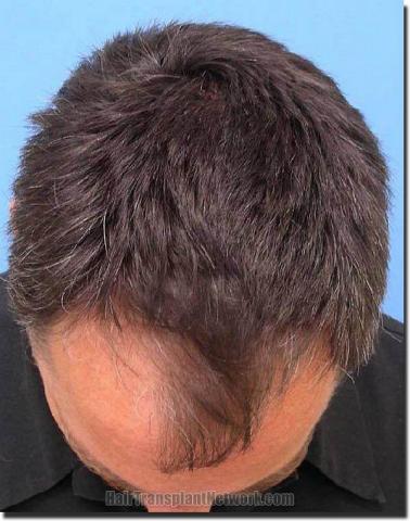 Hair restoration procedure results