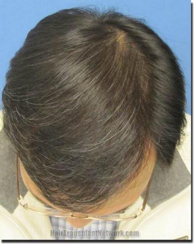 Hair restoration procedure results