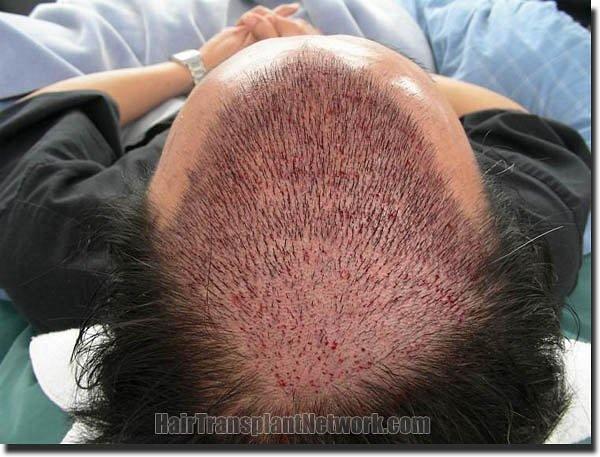 Hair restoration procedure results