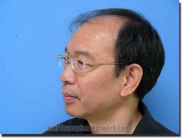 Hair restoration procedure results