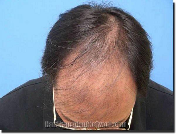 Hair restoration procedure results