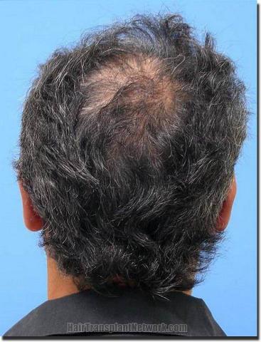 Hair restoration procedure results