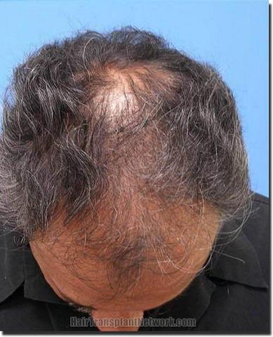 Hair restoration procedure results