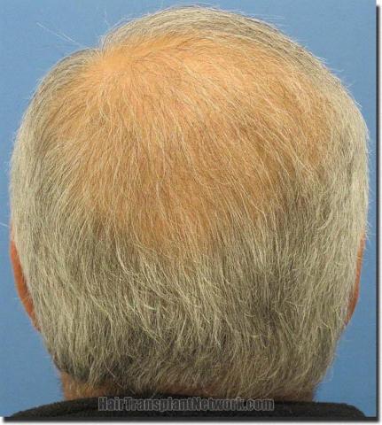 Hair restoration procedure results