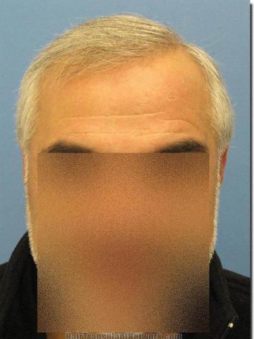 Hair restoration procedure results