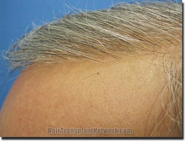 Hair restoration procedure results