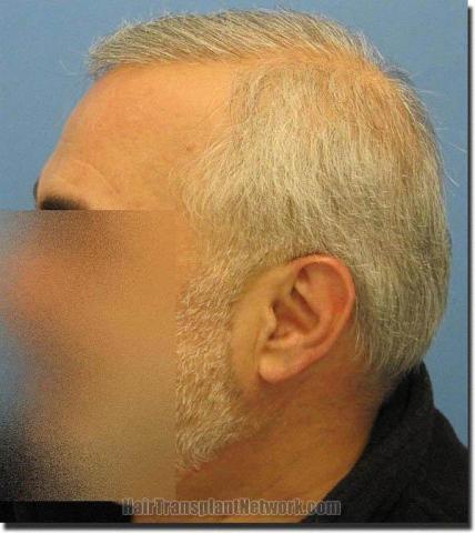 Hair restoration procedure results