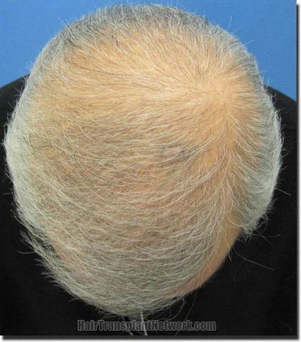 Hair restoration procedure results