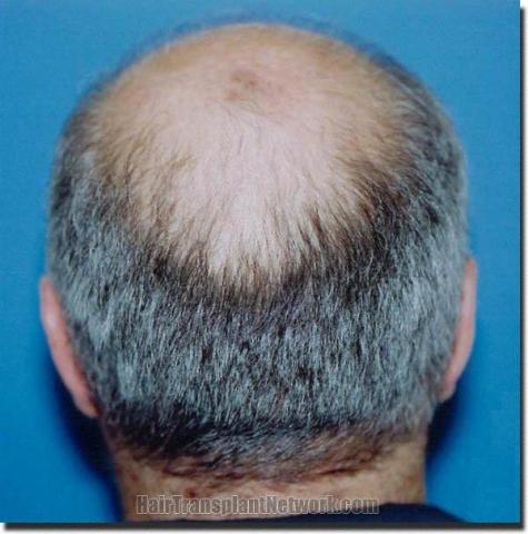 Hair restoration procedure results