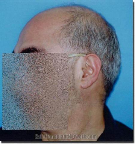 Hair restoration procedure results