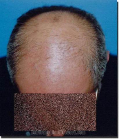 Hair restoration procedure results