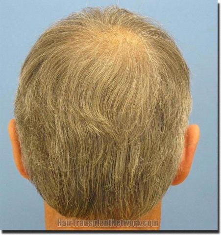 Hair restoration procedure results