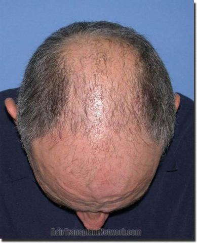 Hair restoration procedure results